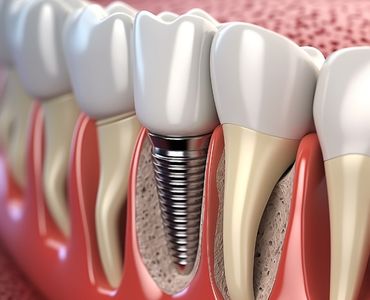 Trabzon Implant Diş